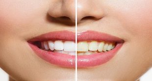 Is Teeth Whitening Effective for Discolored Teeth?