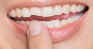 5 Types of Broken Teeth and How Different Cosmetic Dentistry Procedures Can Fix Them
