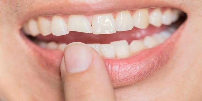 5 Types of Broken Teeth and How Different Cosmetic Dentistry Procedures Can Fix Them