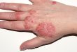 What Happens During an Eczema Consultation?