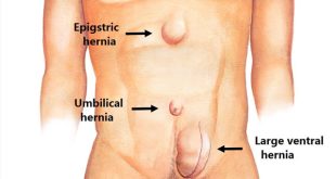 Signs of a Hernia -How to Determine If You Have One